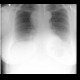 Mediastinal expansion: X-ray - Plain radiograph